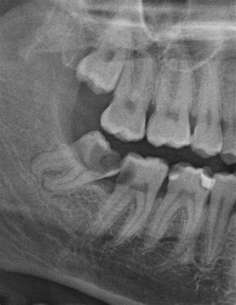 Wisdom Teeth - Hobart Orofacial Pain and Special Needs Clinic