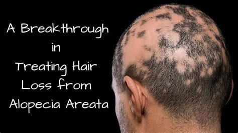 A Breakthrough in Treating Hair Loss from Alopecia Areata - Mom at Work