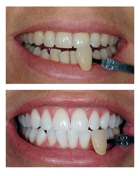 Teeth Whitening Bromley | All Smiles Dental | Tooth Whitening Bromley