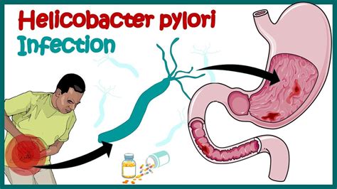 Helicobacter Pylori Infection | Gastric ulcer | Causes, Signs and ...