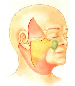 Extended SMAS Facelift Technique Infographic - The Institute of Aesthetic Medicine