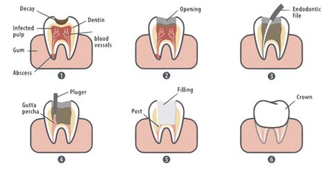 Root Canal Claremont CA | What is a Root Canal Procedure