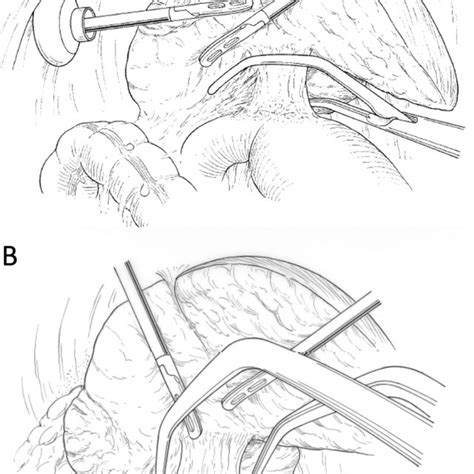 The Pringle maneuver using the LSVC technique. Lateral LSVC (A) and... | Download Scientific Diagram