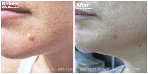 Mole Removal Before & After | Beauty-Full Spa