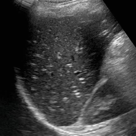 Liver | Radiology Key