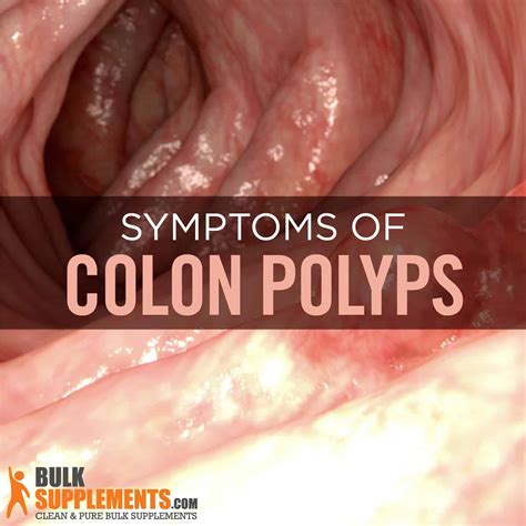 Colon Polyps: Symptoms, Causes & Treatment