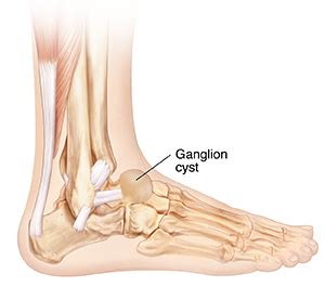 Ganglion Cyst | Saint Luke's Health System