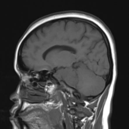 Petroclival meningioma | Radiology Case | Radiopaedia.org