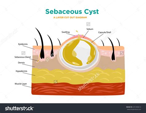 Sebaceous clipart - Clipground