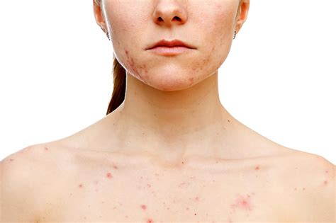 Chest Acne: What Causes It and How to Get Rid of It | The Healthy