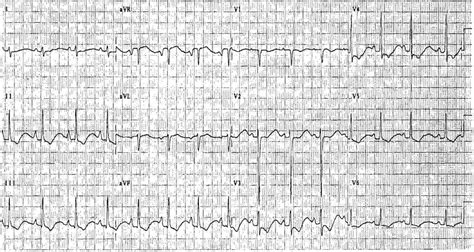 Hypokalemia ECG Changes [With Examples] - Manual of Medicine