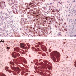 Histological examination of the sentinel lymph node. The sentinel lymph... | Download Scientific ...