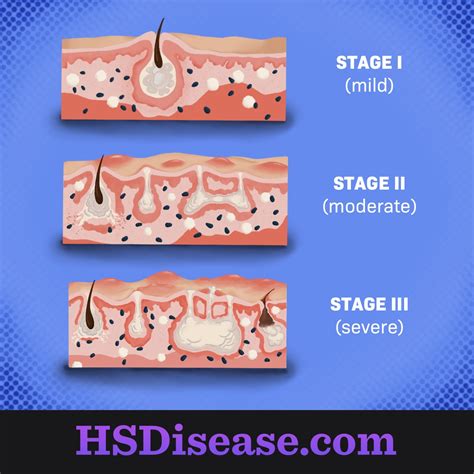 Hidradenitis Suppurativa Diagnosis: Physical Examination