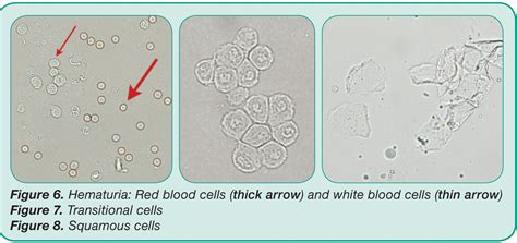 Elevated white blood cells in urine | High white blood cell count Causes. 2020-11-05