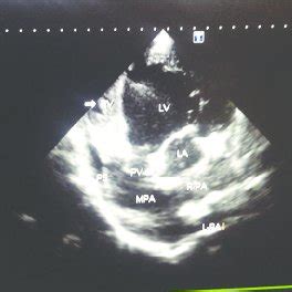 Echocardiography showing the pulmonary valve of the pulmonary trunk... | Download Scientific Diagram