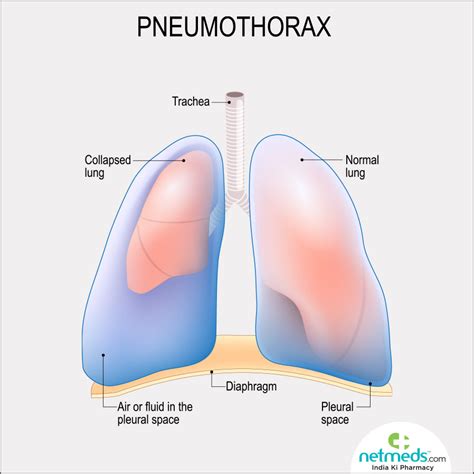 Pneumothorax Causes Signs Symptoms Treatment