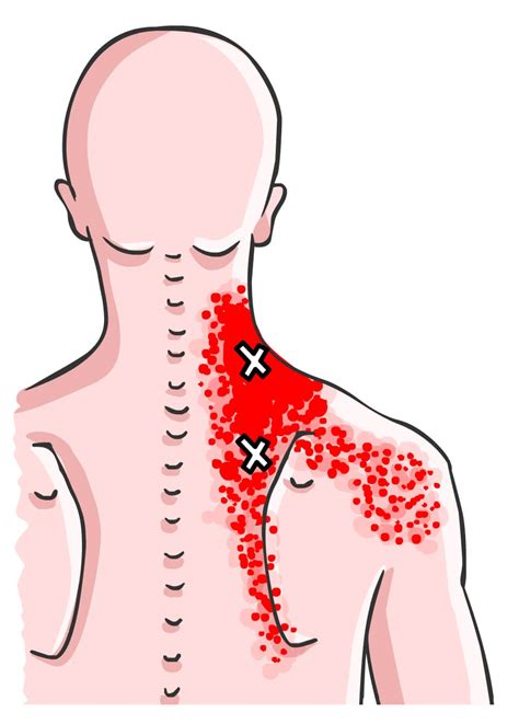 Levator Scapulae Trigger Points