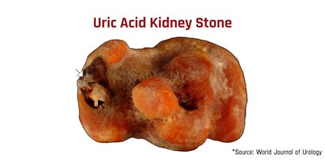 Uric Acid Kidney Stones Stopped For Good! | Stone Relief