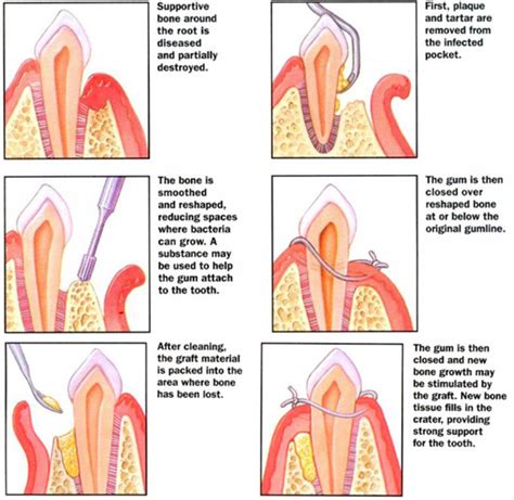 Advanced Dental Specialists :: Periodontal Surgery