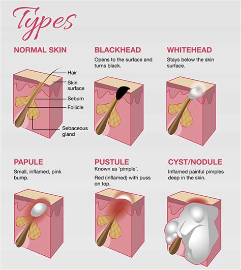 Types of Acne | Skin aesthetics, Skin advice, Types of acne