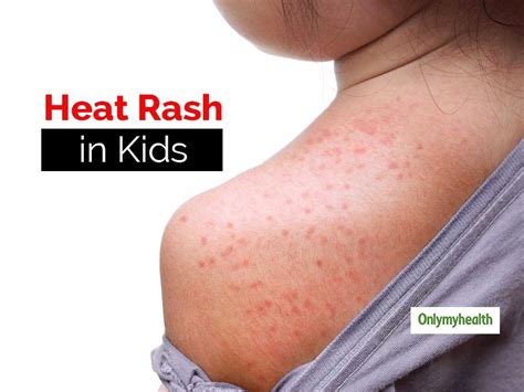 Fine Beautiful Info About How To Get Rid Of Heat Rash - Assistancecorporation