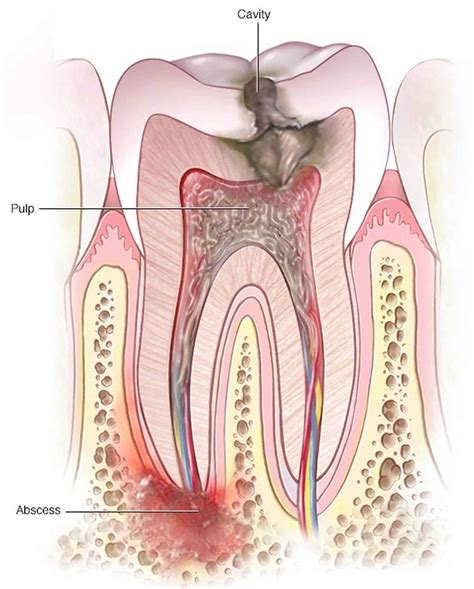 Periapical abscess causes, symptoms, diagnosis, treatment & prognosis