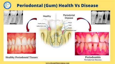 periodontal disease Archives - Prestige Dental Care