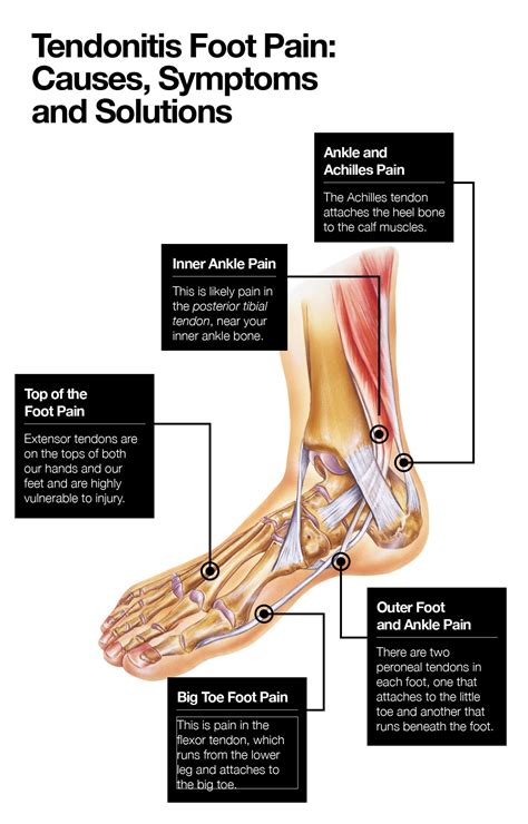 Tendonitis Foot Pain: Causes, Symptoms and Solutions – The Amino Company