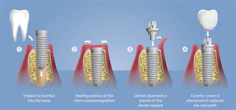 Single Tooth Dental Implants | Newport News, VA