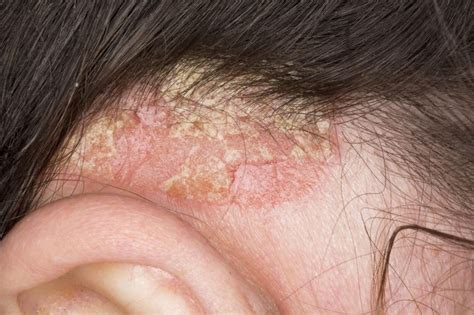 Plaque Psoriasis Hair Loss at Andrew Knight blog