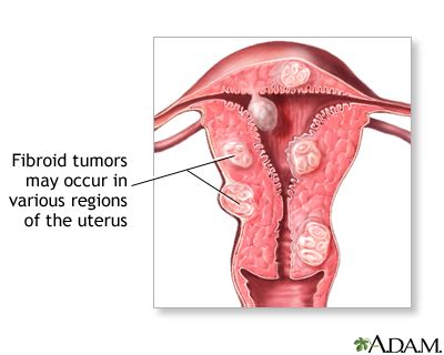 Fibroid tumors: MedlinePlus Medical Encyclopedia Image