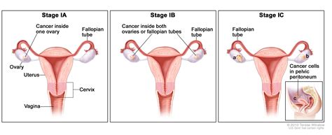 Ovarian Germ Cell Tumors Treatment (PDQ®)—Patient Version - National Cancer Institute