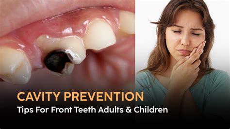 Cavity Prevention Tips for Front Teeth in Adults & Children | Blog