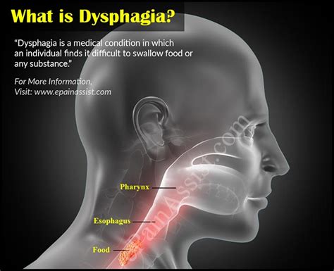 Dysphagia Symptoms, Causes, Treatments Dallas TX - Kedia