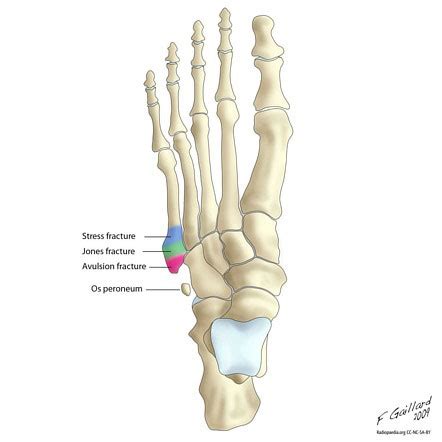 5th Metatarsal Bone Pain