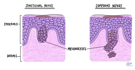 Compound Nevus Histology