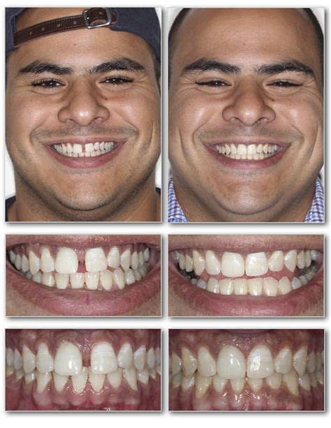 Invisalign Before and After — Invisalign Studio