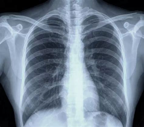 Lung Cancer X-Ray Photos — Examples of Different Types of Results ...