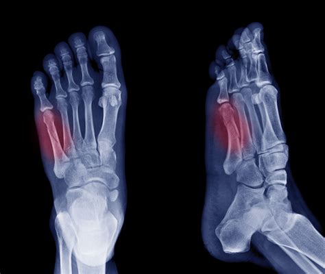 Fifth Metatarsal or Jones Fracture