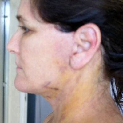 Lower Facelift Recovery Photos (26) » Facelift: Info, Prices, Photos, Reviews, Q&A