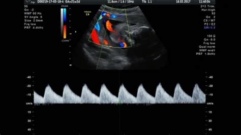 Ultrasound Baby 22 Weeks Part 1 Stock Footage Video (100% Royalty-free) 29607337 | Shutterstock