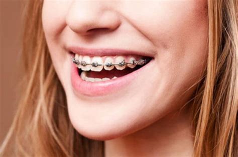 Why You Should Wear Your Retainer After Braces. | New Braunfels Braces