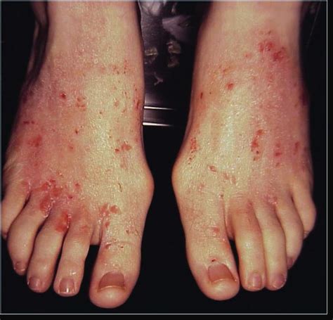 pruritus symptoms - pictures, photos