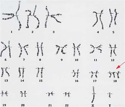 trisomy-18.html 08_08-trisomy-18.jpg