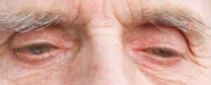 Sagging Eye Syndrome: Causes, Symptoms, Diagnosis & Treatment - Daily Medicos