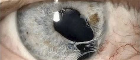 Broken iris in an eye : r/oddlyterrifying