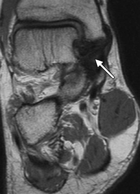 MR Imaging of Deltoid Ligament Pathologic Findings and Associated Impingement Syndromes ...