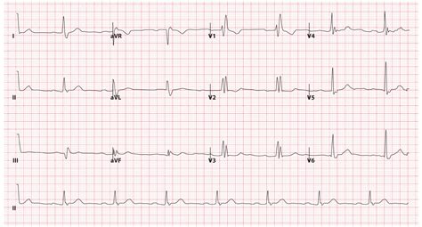 Bundle Branch Blocks (Part 1 – Left and Right Bundle Branch Blocks) - Medical Exam Prep