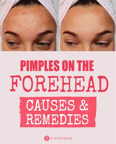 How To Get Rid Of Pimples On Forehead | Pimples on forehead, Forehead acne, Forehead acne cause