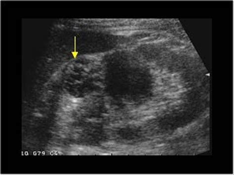 Urinary Tract and male reproductive system | 2.1 Kidney and ureter : Case 2.1.3 Renal cysts ...